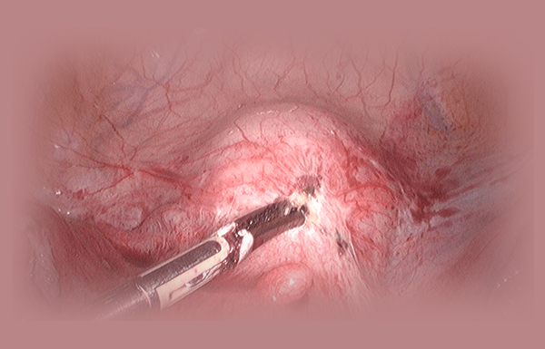 Laparoscopic Hysterectomy in Severe Endometriosis