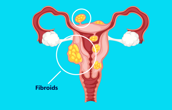 Laparoscopic Hysterectomy in Big Size Fibroids