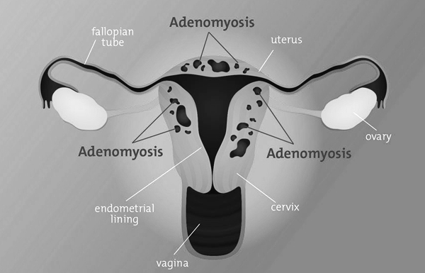 Laparoscopic Hysterectomy in case of Adenomyosis