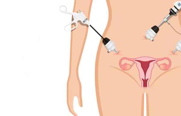 Myths about Hysterectomy Surgery