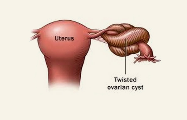 Twisted Ovarian Cyst Surgery in Kolkata