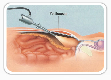 Keyhole (Laparoscopic Surgery)