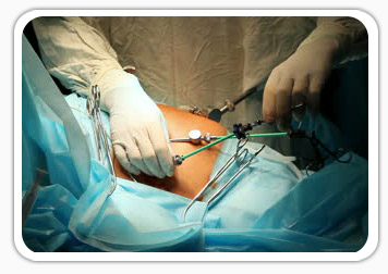 Gynae Laparoscopic Surgery