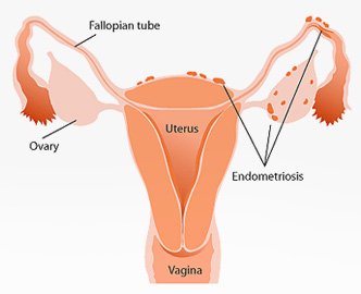 Dr. Sankar Dasmahapatra - Consultant Gynecologist :: Kolkata, Obstetrician  in Kolkata, Gyne Doctor in Kolkata, Surgery, Surgeon, Low Cost, Best, Top,  Specialist, Treatment, Doctor, in, for, at, North Kolkata, Salt Lake,  Teghoria